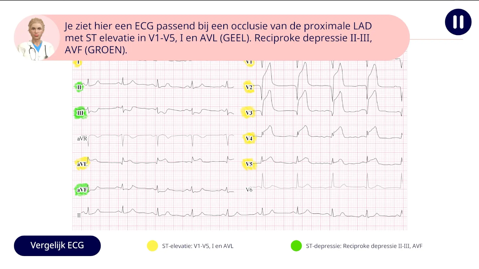 het 12-afleidingen-ecg systematisch lezen
